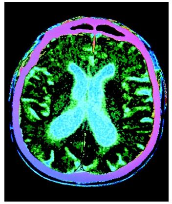 A computerized axial tomography (CAT) scan of a human brain with Parkinson's disease, showing atrophy. Neurodegenerative diseases such as Parkinson's affect brain cells, usually later in life.
