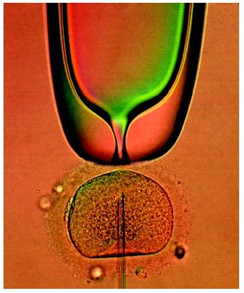 In vitro fertilization: a needle injecting sperm DNA into a human egg.