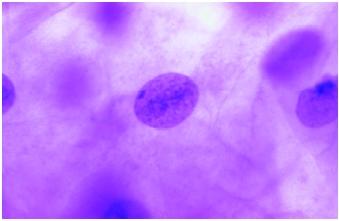 A Barr body_a condensed X chromosome_in a female squamous epithelium cell at interphase.