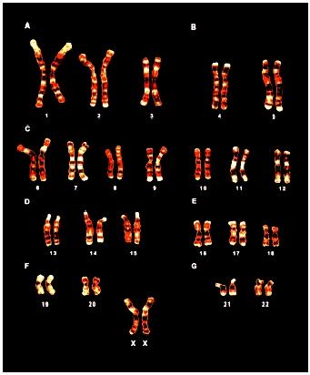Normal human female chromosomes (XX) in karyotype (their ordered set). The stained banding reveals variations in the DNA sequence composition.