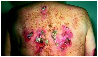 Syphilitic infection on a man's back. Syphilis is classified as a "reportable" disease: when a case of syphilis is diagnosed, it must be reported to a proper health or government agency to prevent its spread.