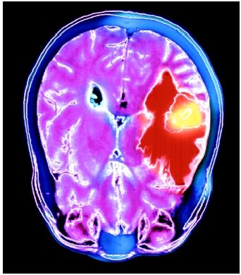A colored magnetic resonance imaging (MRI) scan of the axial section of the human brain showing a metastatic tumor (yellow).
