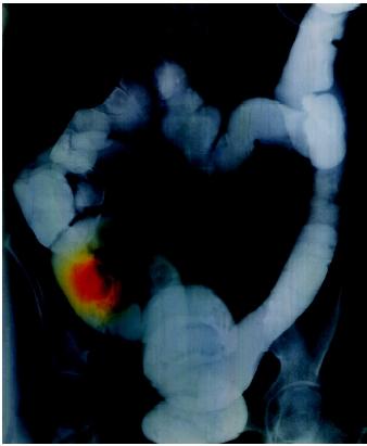 Colored barium enema X ray of a human abdomen showing cancer of the ascending colon. The tumor appears over the right pelvic bone (left on image).