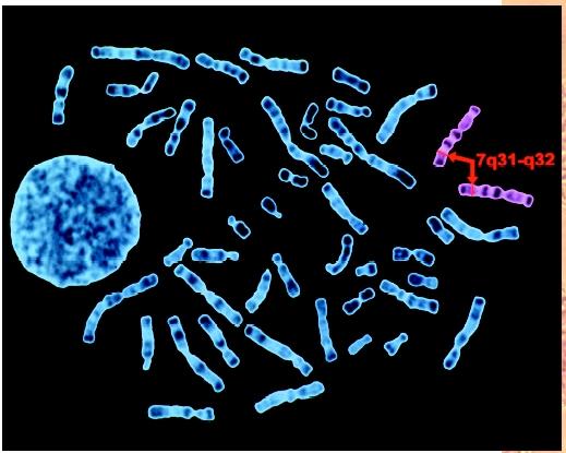 A photomicrograph of human chromosomes showing a mutation on gene 7, which is responsible for cystic fibrosis.