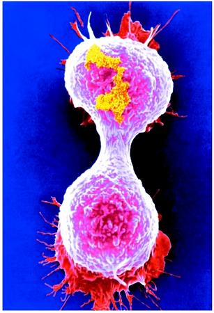 A colored scanning electron micrograph of a breast cancer cell dividing.