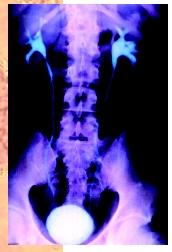 A color-enhanced normal intravenous pyelogram X ray displaying the drainage of urine from the kidneys through the ureter toward the bladder.