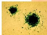 Cancer cells infected with a bioengineered adenovirus.