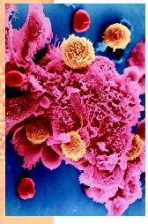 A scanning electron micrograph of a cancer cell (red in image) being attacked by tumorinfiltrating lymphocytes.