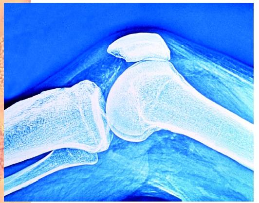 An X ray of the human knee joint with the patella, the bone located within the quadriceps tendon, which wraps over the front of the knee, forming the kneecap.