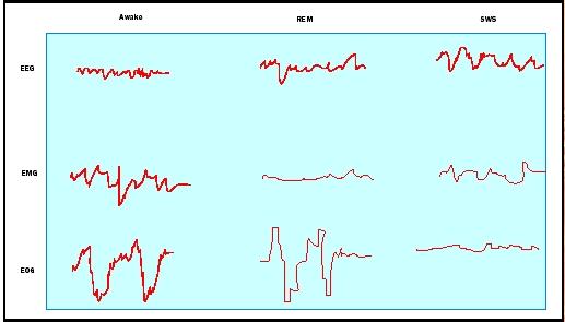 Figure 2. Electroencephalogram (EEG), electromyogram (EMG), and electrooculogram (EOG) show activity of the brain, muscles, and eyes during three different states: wakefulness, REM sleep, and slow-wave sleep (SWS).