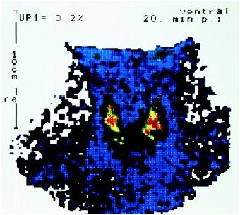 A color-enchanced scintigram (gamma scan) of a human thyroid gland.